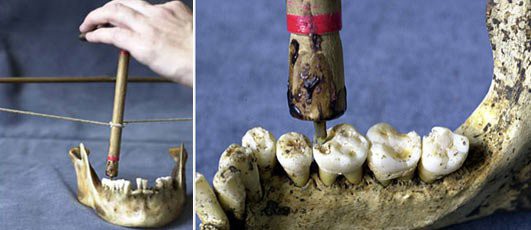 11. Самая древняя стоматология (9000 лет). история, самые первые, факты
