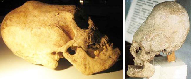 Версии: Зачем древние люди меняли себе форму черепа?