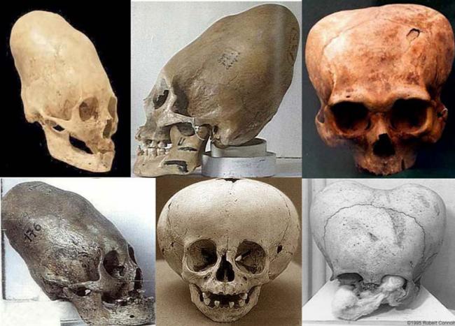 Версии: Зачем древние люди меняли себе форму черепа?